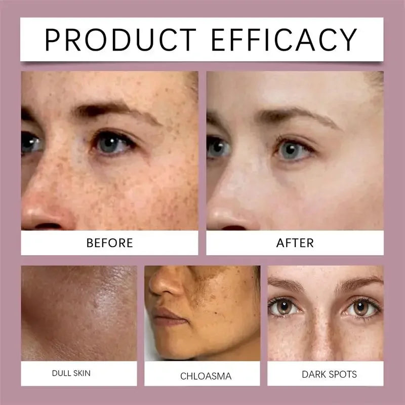 Whitening Freckle Cream Melasma Dark Spots Pigmentation Removal Products Fade Stain Melanin Repair Brighten Korean Skin Care New