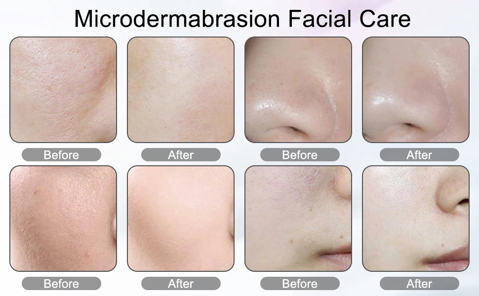 3in1 Diamond Microdermabrasion Machine For Facial Skin Care Blackhead Removal Acne Wrinkle Vacuum & Spray Tool