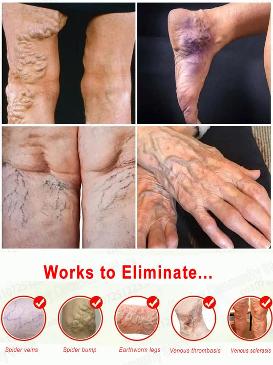 Painless removal of varicose veins, phlebitis, spider legs, prevent varicose veins, promote blood circulation