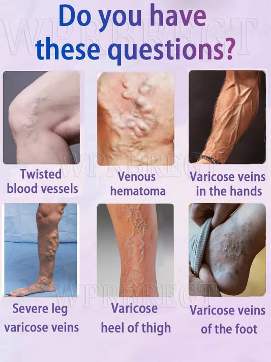 New Varicose Veins Laser Relieves Spider Legs Pain, Eliminates Vasculitis and Thrombophlebitis, Therapeutic Laser Pointer