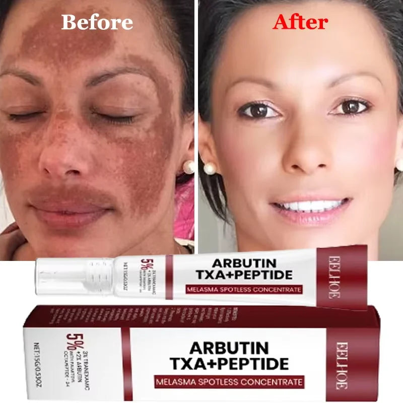Whitening Freckle Cream Melasma Dark Spots Pigmentation Removal Products Fade Stain Melanin Repair Brighten Korean Skin Care New