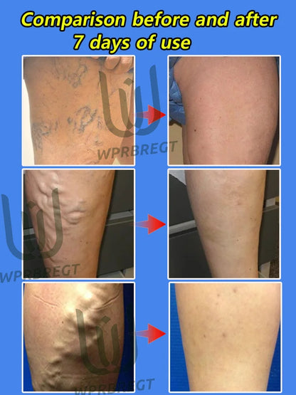 Painless removal of varicose veins, phlebitis, spider legs, prevent varicose veins, promote blood circulation