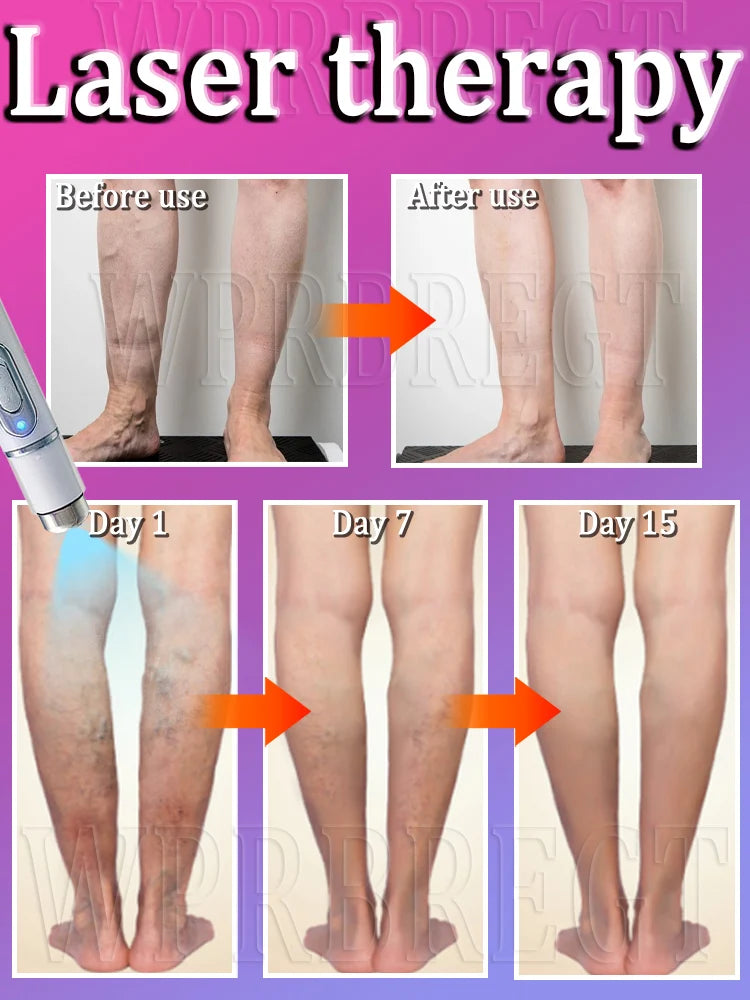 New Varicose Veins Laser Relieves Spider Legs Pain, Eliminates Vasculitis and Thrombophlebitis, Therapeutic Laser Pointer