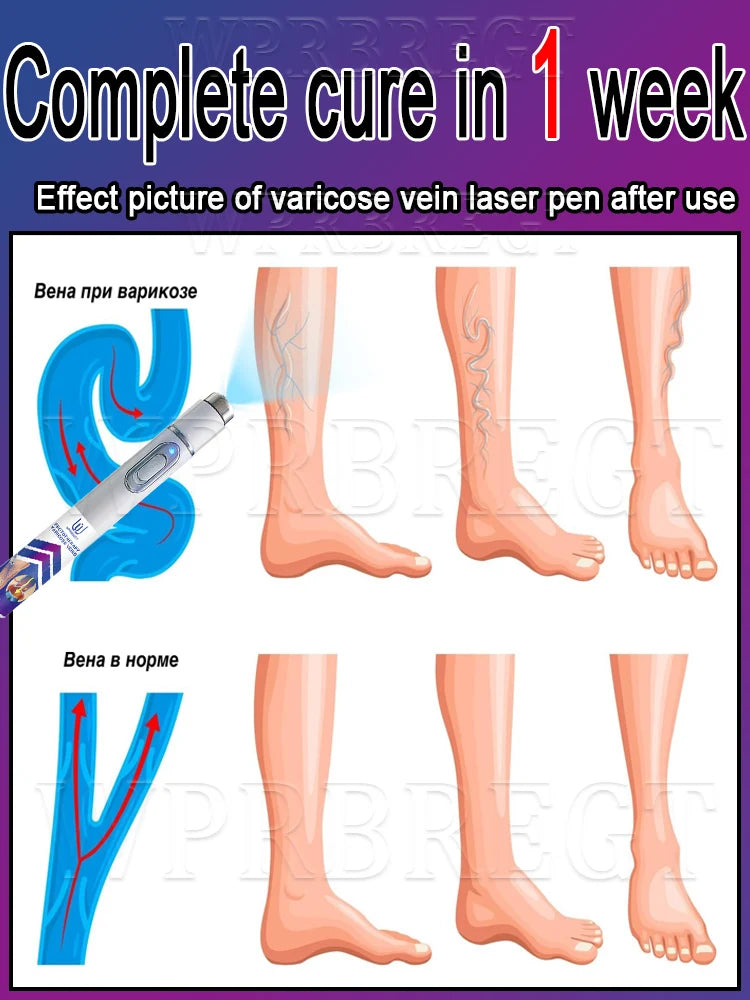 New Varicose Veins Laser Relieves Spider Legs Pain, Eliminates Vasculitis and Thrombophlebitis, Therapeutic Laser Pointer